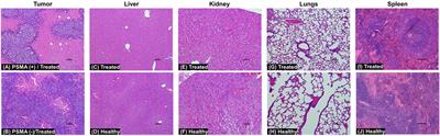 Development and therapeutic evaluation of 5D3(CC-MLN8237)3.2 antibody-theranostic conjugates for PSMA-positive prostate cancer therapy